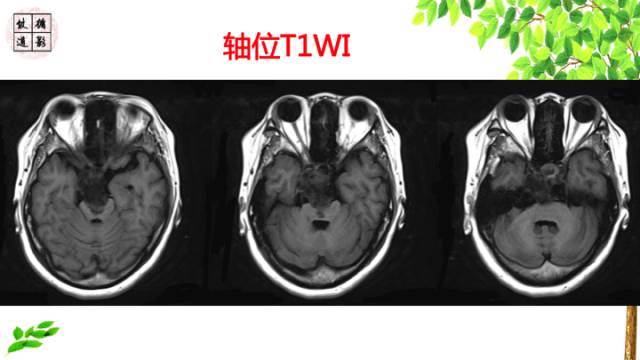 【病例】颅底软骨肉瘤1例CT及MR影像诊断思路