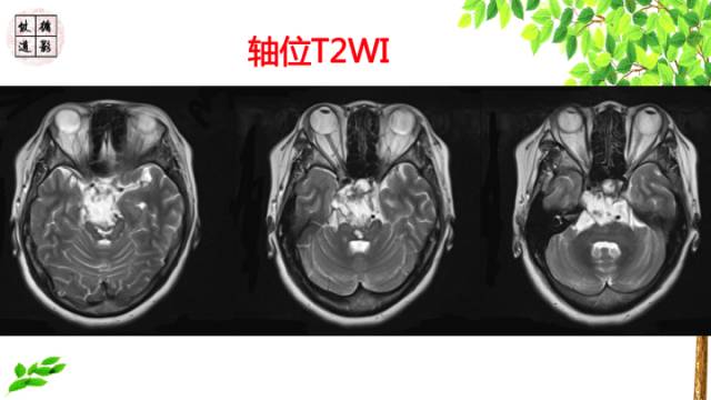 【病例】颅底软骨肉瘤1例CT及MR影像诊断思路