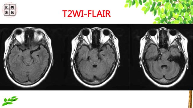 【病例】颅底软骨肉瘤1例CT及MR影像诊断思路