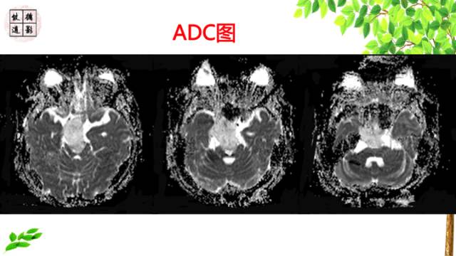 【病例】颅底软骨肉瘤1例CT及MR影像诊断思路