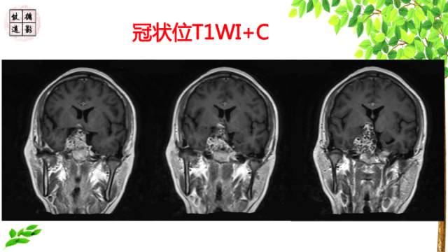 【病例】颅底软骨肉瘤1例CT及MR影像诊断思路