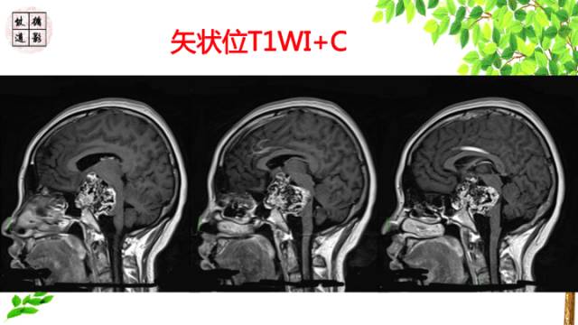 【病例】颅底软骨肉瘤1例CT及MR影像诊断思路