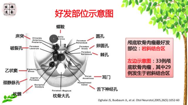 【病例】颅底软骨肉瘤1例CT及MR影像诊断思路