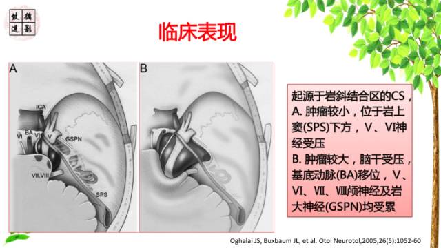 【病例】颅底软骨肉瘤1例CT及MR影像诊断思路