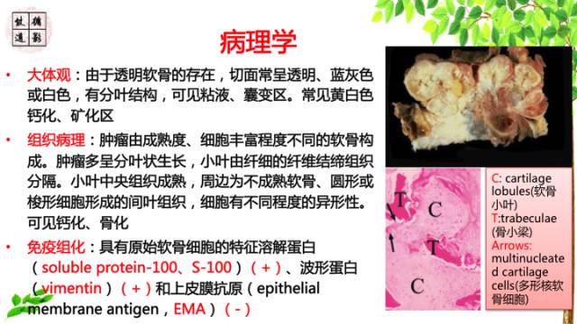 【病例】颅底软骨肉瘤1例CT及MR影像诊断思路