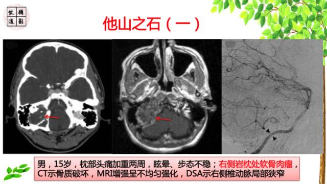 【病例】颅底软骨肉瘤1例CT及MR影像诊断思路