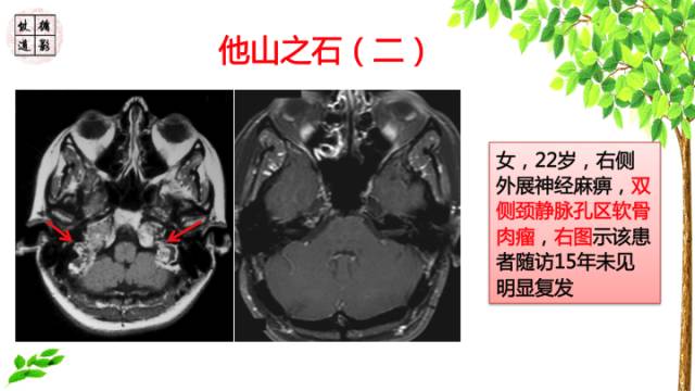 【病例】颅底软骨肉瘤1例CT及MR影像诊断思路