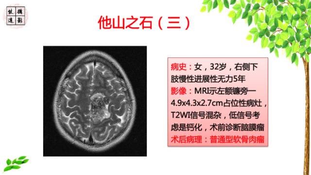 【病例】颅底软骨肉瘤1例CT及MR影像诊断思路