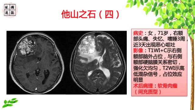 【病例】颅底软骨肉瘤1例CT及MR影像诊断思路
