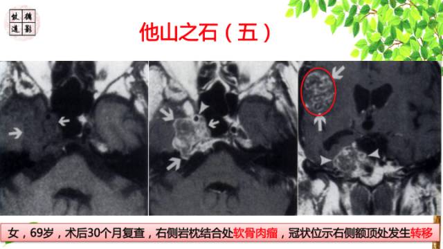 【病例】颅底软骨肉瘤1例CT及MR影像诊断思路