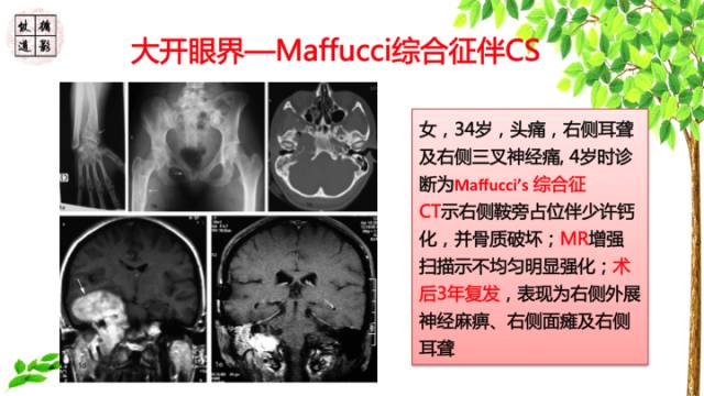 【病例】颅底软骨肉瘤1例CT及MR影像诊断思路
