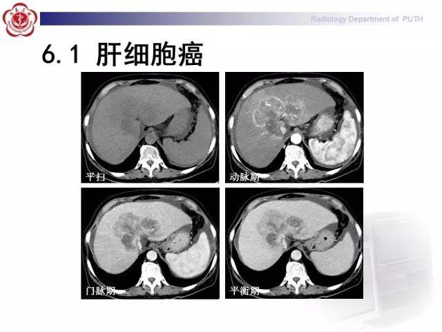 【病例】肝腺瘤1例CT及MR影像表现