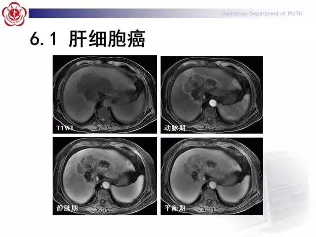 【病例】肝腺瘤1例CT及MR影像表现