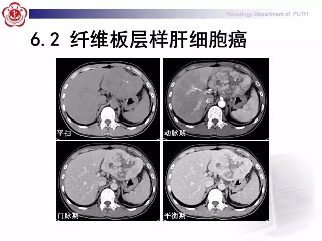 【病例】肝腺瘤1例CT及MR影像表现