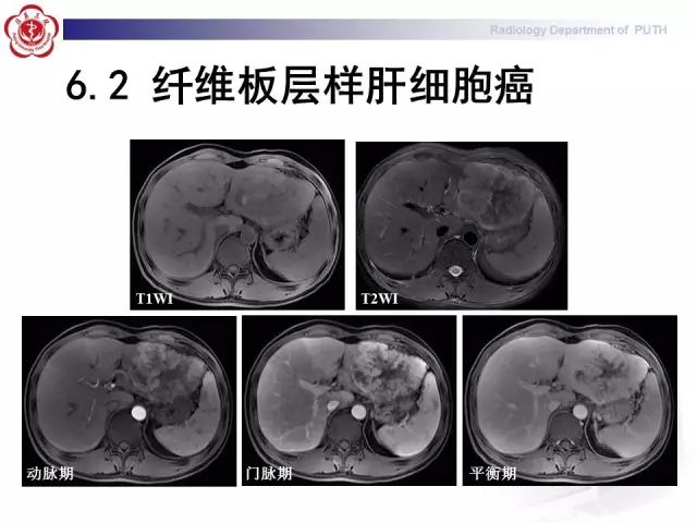 【病例】肝腺瘤1例CT及MR影像表现