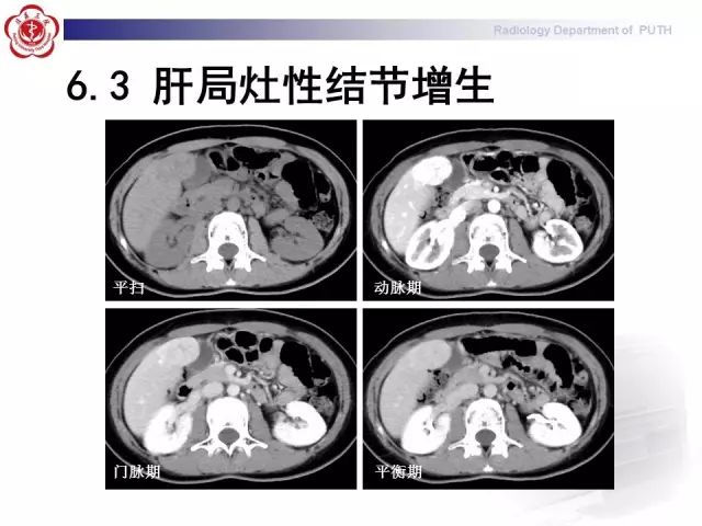 【病例】肝腺瘤1例CT及MR影像表现