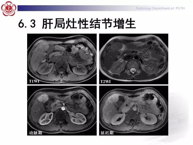 【病例】肝腺瘤1例CT及MR影像表现