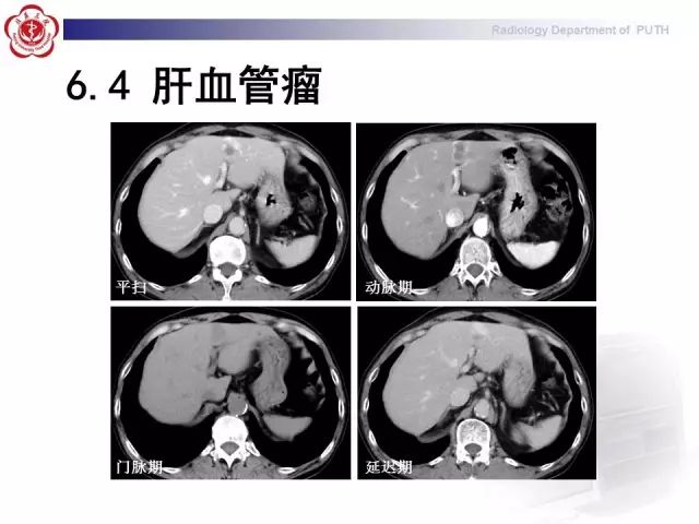【病例】肝腺瘤1例CT及MR影像表现