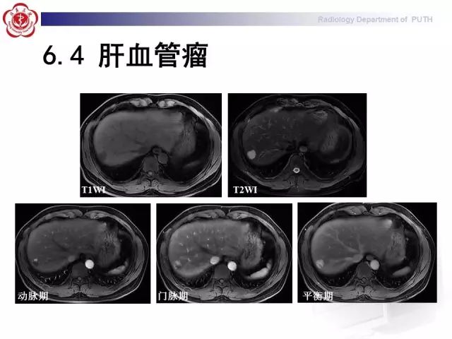 【病例】肝腺瘤1例CT及MR影像表现