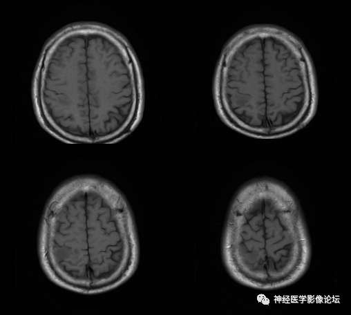 【病例】右顶叶胶质母细胞瘤1例MR影像表现 【病例】右顶叶胶质母细胞瘤1例MR影像表现