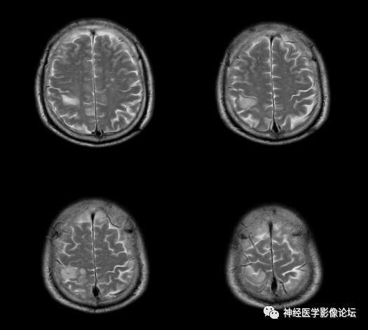 【病例】右顶叶胶质母细胞瘤1例MR影像表现 【病例】右顶叶胶质母细胞瘤1例MR影像表现