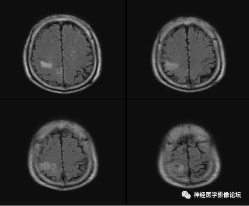 【病例】右顶叶胶质母细胞瘤1例MR影像表现 【病例】右顶叶胶质母细胞瘤1例MR影像表现