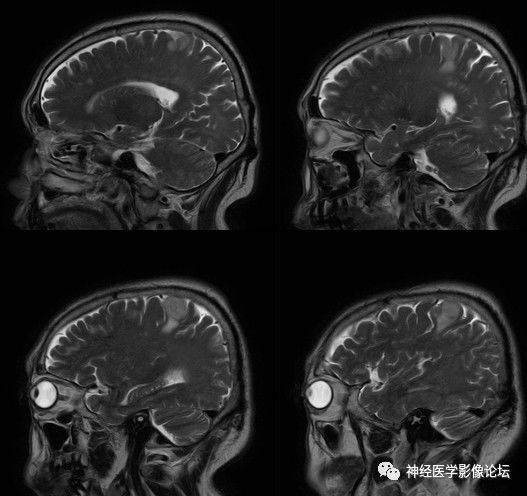 【病例】右顶叶胶质母细胞瘤1例MR影像表现 【病例】右顶叶胶质母细胞瘤1例MR影像表现