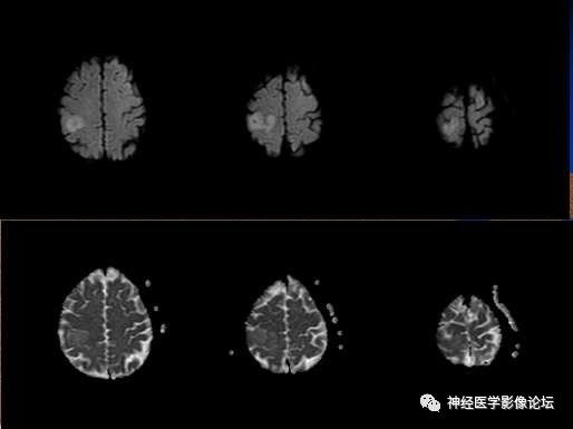 【病例】右顶叶胶质母细胞瘤1例MR影像表现 【病例】右顶叶胶质母细胞瘤1例MR影像表现