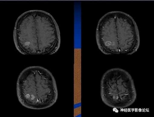 【病例】右顶叶胶质母细胞瘤1例MR影像表现 【病例】右顶叶胶质母细胞瘤1例MR影像表现