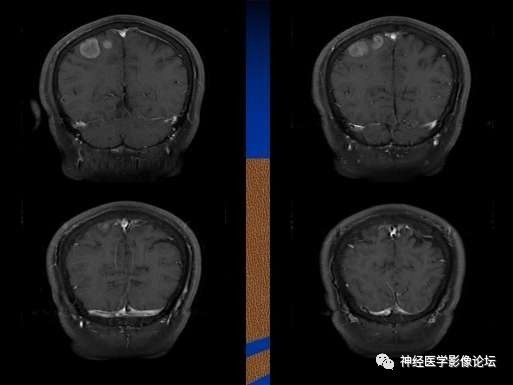 【病例】右顶叶胶质母细胞瘤1例MR影像表现 【病例】右顶叶胶质母细胞瘤1例MR影像表现
