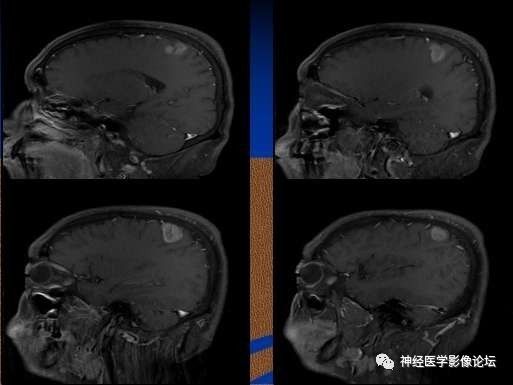 【病例】右顶叶胶质母细胞瘤1例MR影像表现 【病例】右顶叶胶质母细胞瘤1例MR影像表现