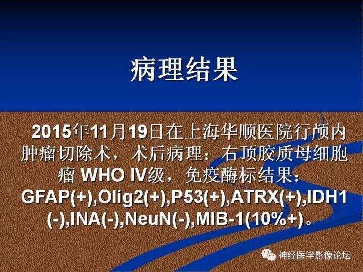 【病例】右顶叶胶质母细胞瘤1例MR影像表现 【病例】右顶叶胶质母细胞瘤1例MR影像表现