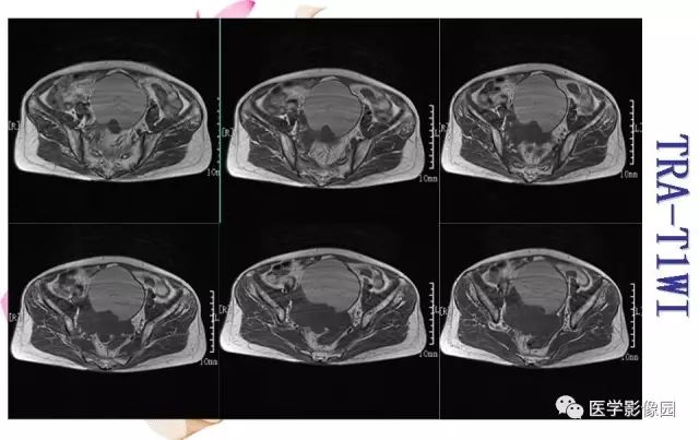 【病例】下腹腔胃肠道外间质瘤1例MR影像表现 【病例】下腹腔胃肠道外间质瘤1例MR影像表现