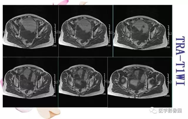 【病例】下腹腔胃肠道外间质瘤1例MR影像表现 【病例】下腹腔胃肠道外间质瘤1例MR影像表现