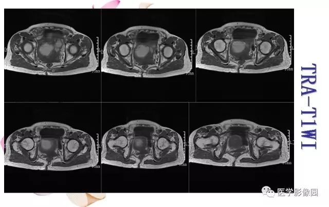 【病例】下腹腔胃肠道外间质瘤1例MR影像表现 【病例】下腹腔胃肠道外间质瘤1例MR影像表现