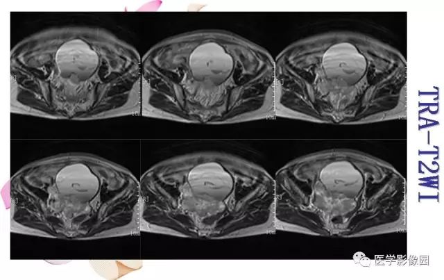 【病例】下腹腔胃肠道外间质瘤1例MR影像表现 【病例】下腹腔胃肠道外间质瘤1例MR影像表现