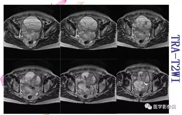 【病例】下腹腔胃肠道外间质瘤1例MR影像表现 【病例】下腹腔胃肠道外间质瘤1例MR影像表现