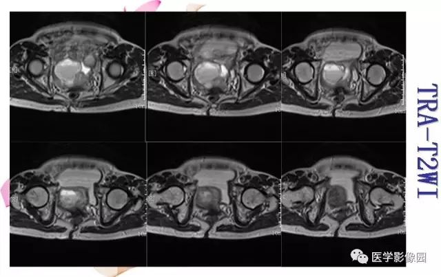 【病例】下腹腔胃肠道外间质瘤1例MR影像表现 【病例】下腹腔胃肠道外间质瘤1例MR影像表现