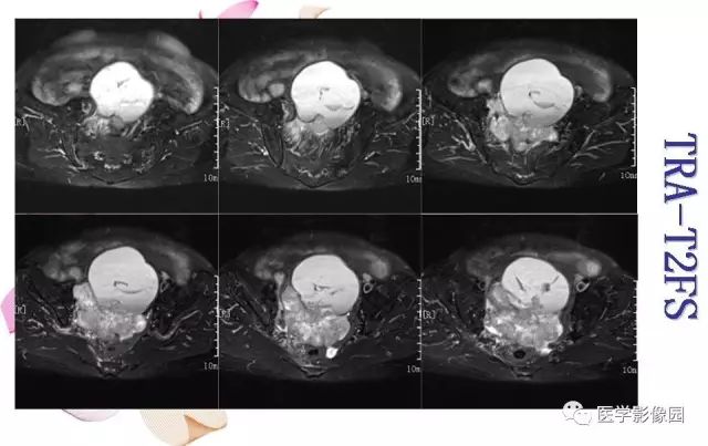 【病例】下腹腔胃肠道外间质瘤1例MR影像表现 【病例】下腹腔胃肠道外间质瘤1例MR影像表现