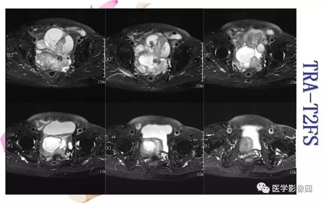 【病例】下腹腔胃肠道外间质瘤1例MR影像表现 【病例】下腹腔胃肠道外间质瘤1例MR影像表现