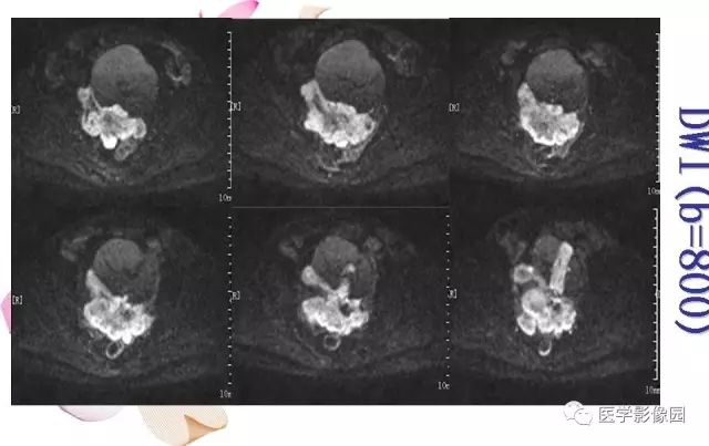 【病例】下腹腔胃肠道外间质瘤1例MR影像表现 【病例】下腹腔胃肠道外间质瘤1例MR影像表现