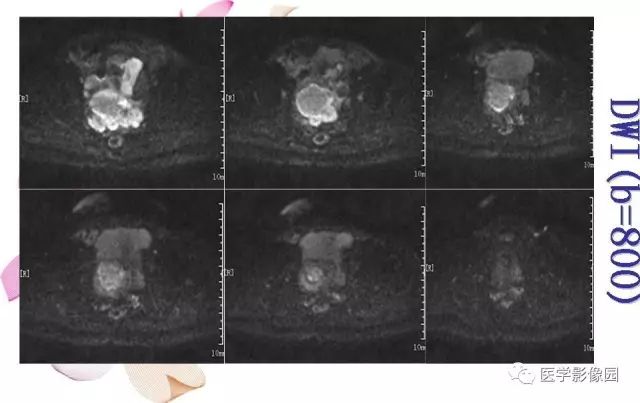 【病例】下腹腔胃肠道外间质瘤1例MR影像表现 【病例】下腹腔胃肠道外间质瘤1例MR影像表现