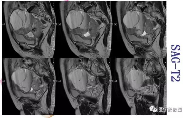【病例】下腹腔胃肠道外间质瘤1例MR影像表现 【病例】下腹腔胃肠道外间质瘤1例MR影像表现