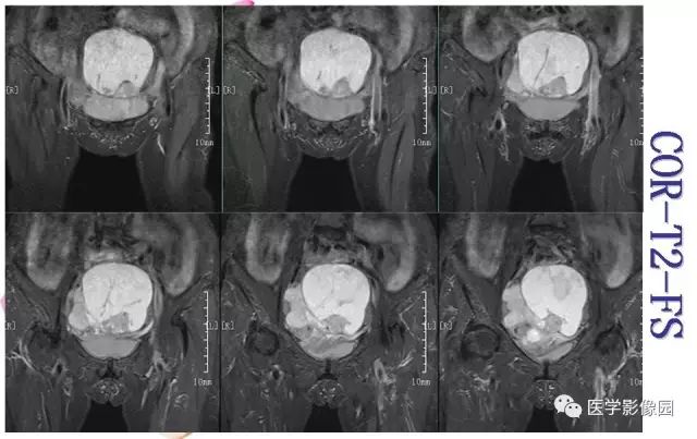 【病例】下腹腔胃肠道外间质瘤1例MR影像表现 【病例】下腹腔胃肠道外间质瘤1例MR影像表现