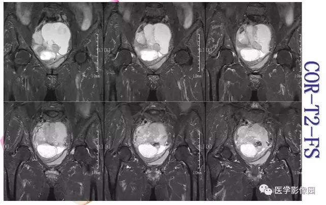 【病例】下腹腔胃肠道外间质瘤1例MR影像表现 【病例】下腹腔胃肠道外间质瘤1例MR影像表现