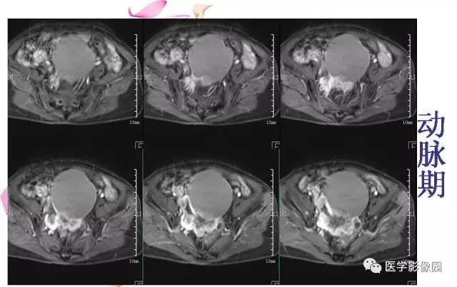 【病例】下腹腔胃肠道外间质瘤1例MR影像表现 【病例】下腹腔胃肠道外间质瘤1例MR影像表现