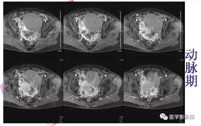 【病例】下腹腔胃肠道外间质瘤1例MR影像表现 【病例】下腹腔胃肠道外间质瘤1例MR影像表现