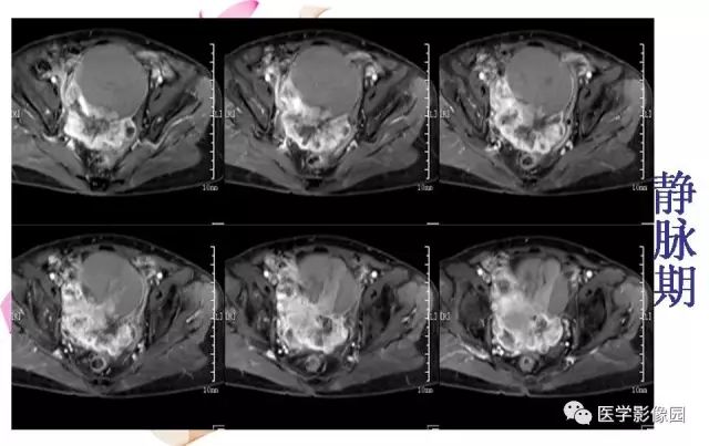 【病例】下腹腔胃肠道外间质瘤1例MR影像表现 【病例】下腹腔胃肠道外间质瘤1例MR影像表现