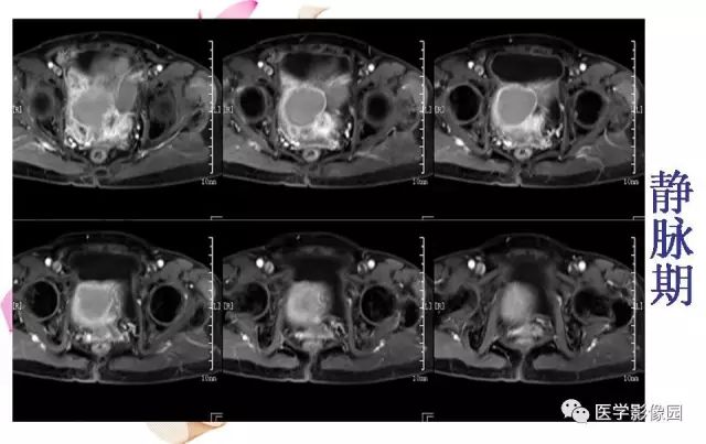 【病例】下腹腔胃肠道外间质瘤1例MR影像表现 【病例】下腹腔胃肠道外间质瘤1例MR影像表现