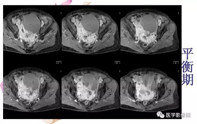 【病例】下腹腔胃肠道外间质瘤1例MR影像表现 【病例】下腹腔胃肠道外间质瘤1例MR影像表现